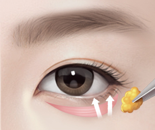 하안검성형술 Step 02