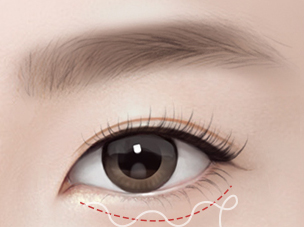 하안검성형술 Step 03